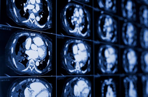 Lung cancer is the deadliest of all cancers, and screening could save many lives − if more people could access it ​​Health – The Conversation