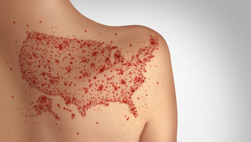 Measles can ravage the immune system and brain, causing long-term damage – a virologist explains ​​Health – The Conversation