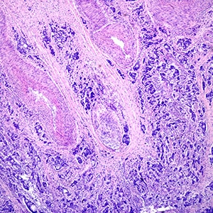 What Is a Gleason Score for Prostate Cancer? ​​American Association for Cancer Research (AACR)